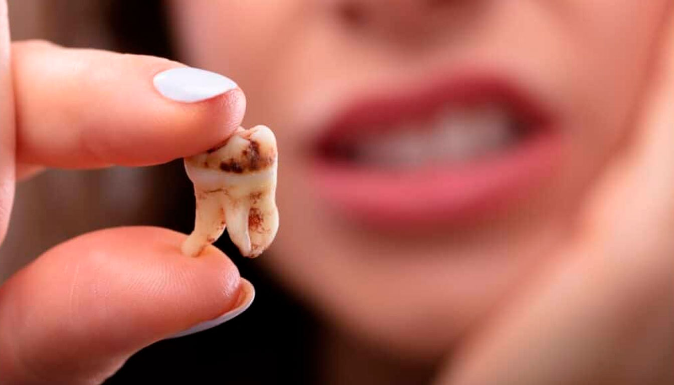 Com quantos anos o Dente Siso nasce? Conteúdo Completo